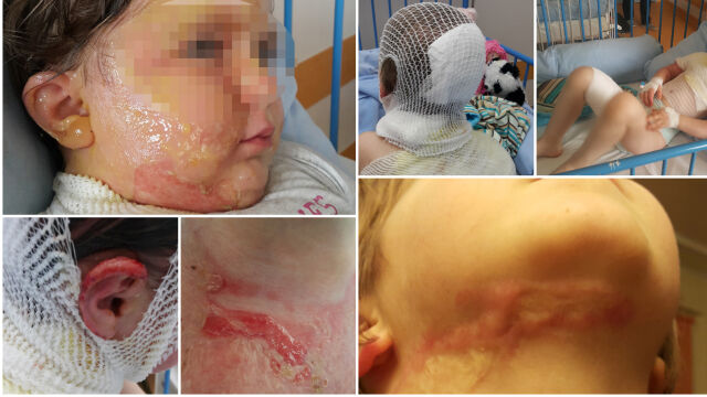 She stumbled and poured a cup of boiling water on the sleeping man
3.5 years old girl. A kindergarten girl sentenced